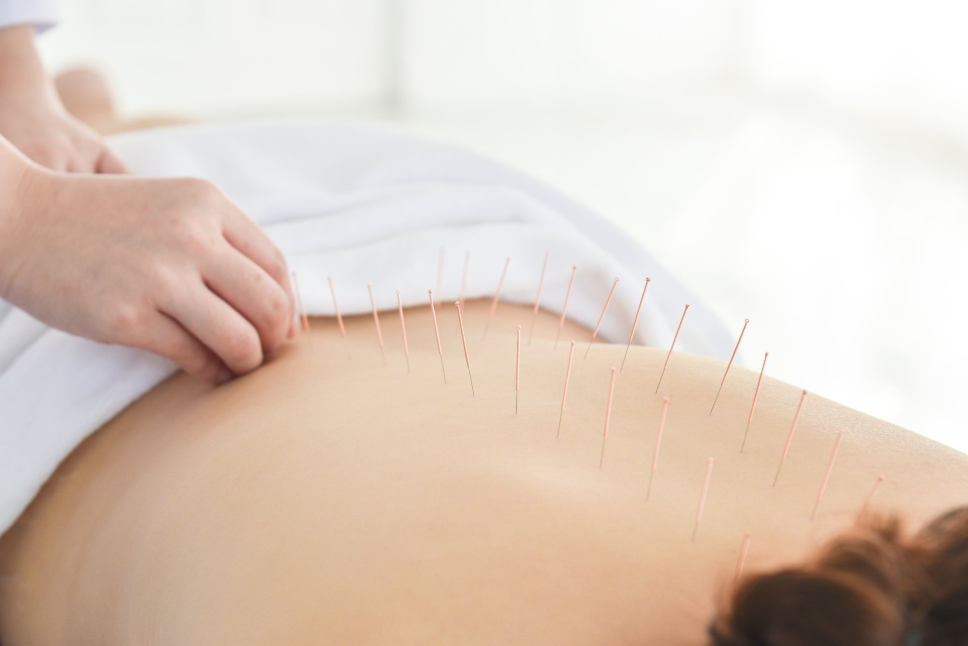 Medical acupuncture at Niddrie Clinic